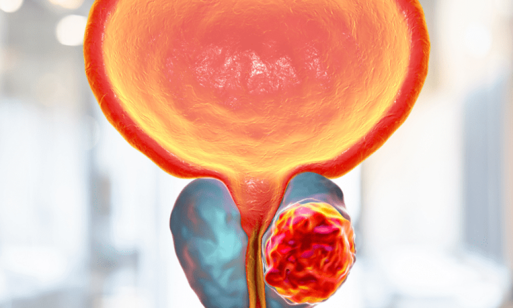 การตรวจมะเร็งต่อมลูกหมากด้วยการตัดชิ้นเนื้อ TRUS C BX