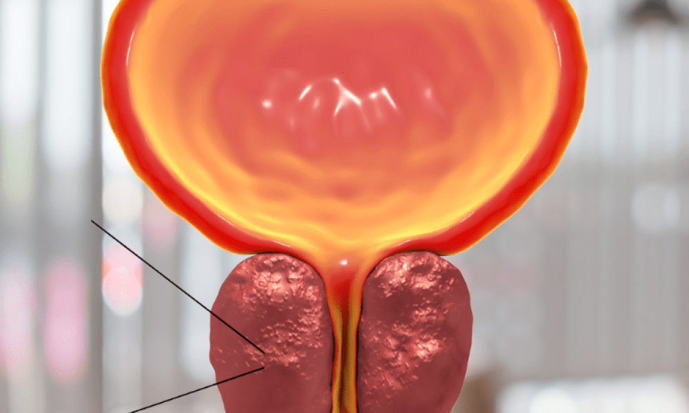 ต่อมลูกหมากโต Benign Prostatic Hyperplasia